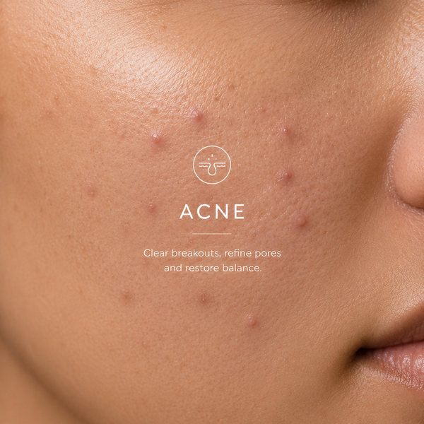 Acne Prone Skin